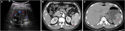 Sclerosing Angiomatoid Nodular Transformation of the Spleen: Analysis of Clinical and Pathological Features in Five Cases
